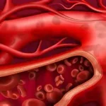 Doorbloeding spierspanning